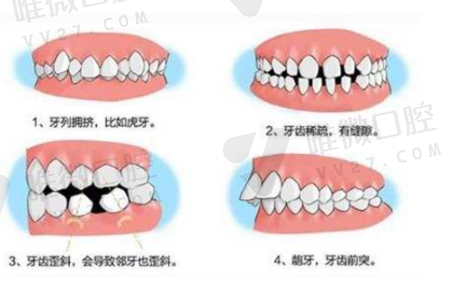怎么区别牙医给你用的假牙,怎么知道自己的假牙是什么材质(图1)